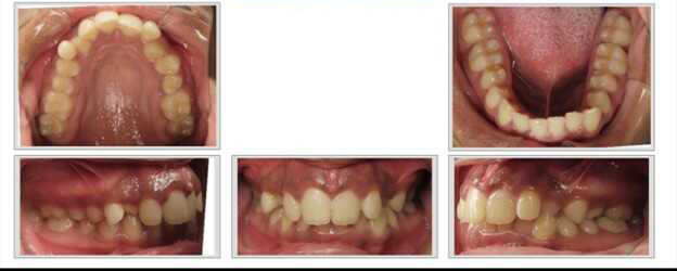 Deep bite and severe crowding before treatment