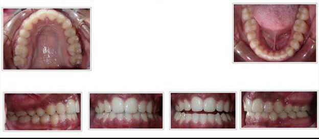 Deep bite and severe crowding after treatment