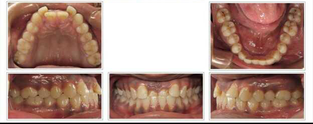 Adult with an underbite treated with Invisalign before treatment