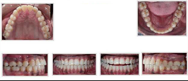 Adult with an underbite treated with Invisalign after treatment