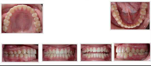 Invisalign teen case (no braces) after treatment