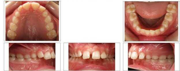 Excessive overjet (front teeth sticking out) before treatment