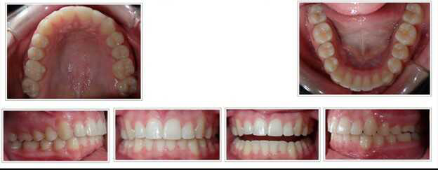 Excessive overjet (front teeth sticking out) after treatment