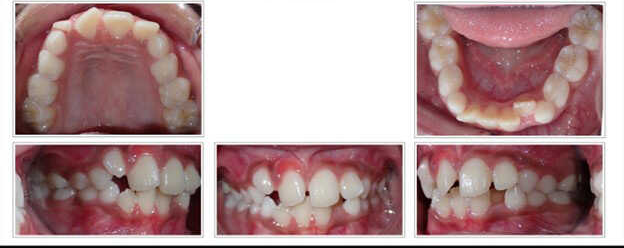 Phase I early interceptive treatment at age 7 before treatment