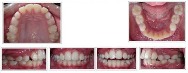 Phase I early interceptive treatment at age 7 after treatment